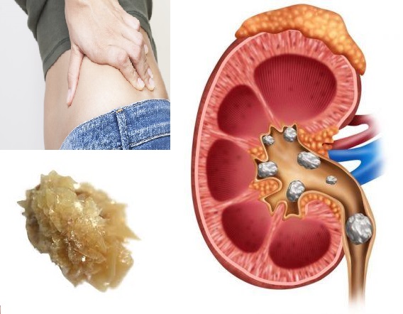 Kidney stones Diagnosis and Treatment